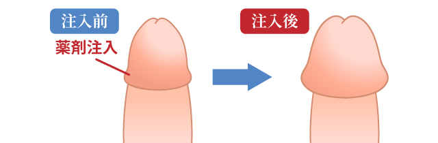 亀頭増大術